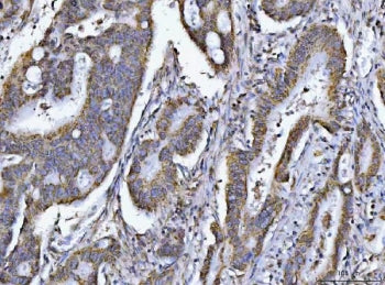 IHC staining of FFPE human colon adenocarcinoma tissue with PCCB antibody. HIER: boil tissue section