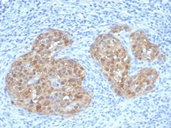 IHC staining of FFPE human cervical carcinoma tissue with CDKN2A antibody (clone rCDKN2A/7659). HIER