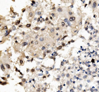 IHC staining of FFPE human liver cancer with MNT antibody. HIER: boil tissue sections in pH8 EDTA fo