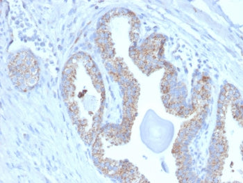 IHC staining of FFPE human prostate carcinoma with TMEPAI antibody (clone PMEPA1/2697). HIER: boil t