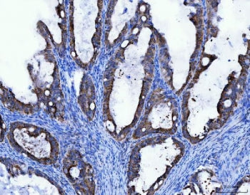 IHC staining of FFPE human ovarian cancer tissue with TFG antibody. HIER: boil tissue sections in pH