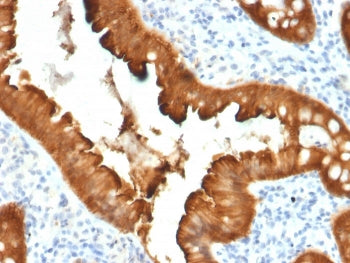 IHC staining of FFPE human colon carcinoma with Villin antibody (clone VIL1/2376). HIER: boil tissue