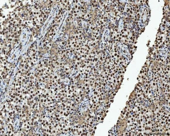 IHC staining of FFPE human testicular cancer tissue with HNRPL antibody. HIER: boil tissue sections
