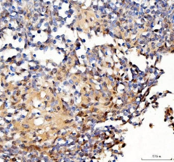 IHC staining of FFPE human lymphoma tissue with Survivin antibody. HIER: boil tissue sections in pH8