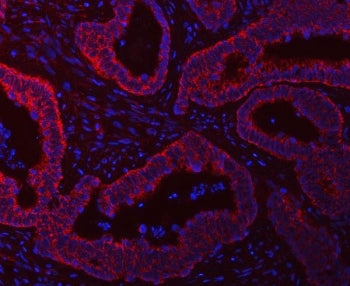 Immunofluorescent staining of FFPE human intestine cancer tissue with SCO1 antibody (red) and DAPI n