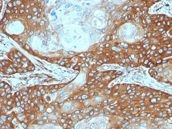 IHC testing of FFPE human cervical carcinoma stained with RPSA antibody. Required HIER: boiling tiss