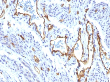 IHC staining of FFPE human angiocarcinoma with recombinant CD31 antibody (clone C31/1395R). Required