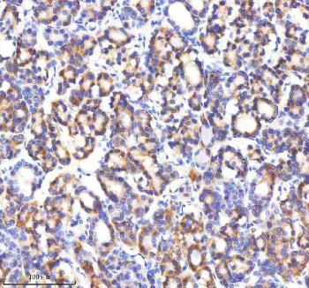 IHC staining of FFPE human thyroid cancer tissue with GABARAPL2 antibody, HRP-secondary and DAB subs