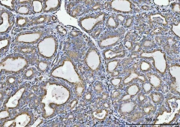 IHC staining of FFPE human thyroiditis tissue with GLDC antibody. HIER: boil tissue sections in pH8