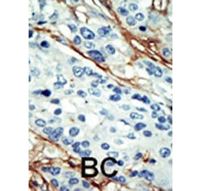 IHC staining of FFPE human breast cancer tissue with NUAK1 antibody. HIER: steam section in pH6 citr