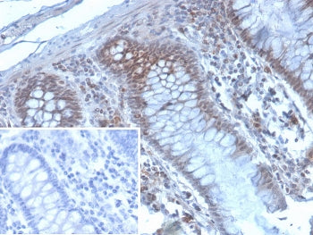 IHC staining of FFPE human colon carcinoma tissue with KMT6 antibody (clone EZH2/4194). Inset: PBS u