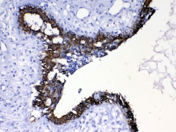 IHC testing of FFPE human breast cancer tissue with Cytokeratin 8 antibody at 1ug/ml. Required HIER: