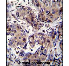 IHC staining of FFPE human breast cancer tissue with MAGE3 antibody. HIER: steam section in pH6 citr