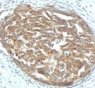 IHC: Formalin-fixed, paraffin-embedded human ovarian carcinoma stained with VEGF antibody (clone SPM