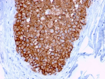IHC staining of FFPE human breast carcinoma with HER2 antibody (clone ERBB2/3078). HIER: boil tissue