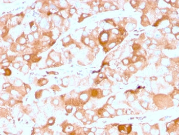 IHC staining of FFPE human breast carcinoma with recombinant Prolactin Receptor antibody (clone rPRL