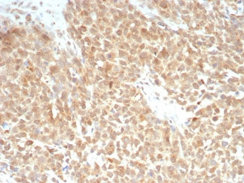 IHC staining of FFPE human triple negative breast cancer tissue with recombinant xCT antibody (clone