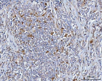IHC staining of FFPE human lymphoma tissue with BCAT1 antibody. HIER: boil tissue sections in pH8 ED