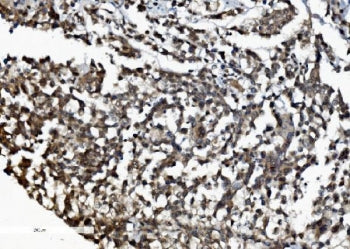 IHC staining of FFPE human pancreatic cancer with DDX1 antibody. HIER: boil tissue sections in pH8 E