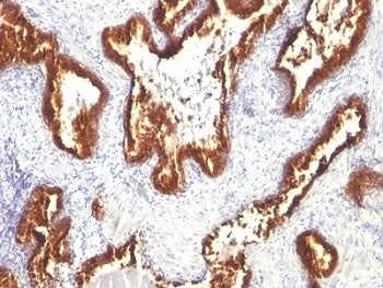 IHC: Formalin-fixed, paraffin-embedded human prostate carcinoma stained with Keratin 18 antibody (cl