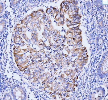 IHC staining of FFPE human gastric adenocarcinoma tissue with GSPT1/2 antibody. HIER: boil tissue se