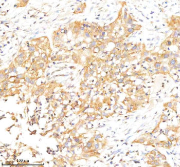 Immunohistochemical staining of RAB27B using anti-RAB27B antibody. RAB27B was detected in a paraffin