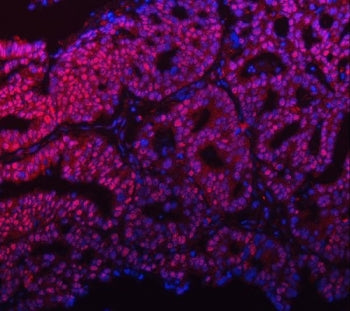 Immunofluorescent staining of FFPE human ovarian cancer tissue with mSin3A antibody (red) and DAPI (