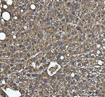 IHC staining of FFPE human liver cancer tissue with C-1-tetrahydrofolate synthase antibody. HIER: bo