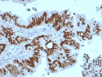 IHC testing of FFPE human colon carcinoma with recombinant p53 antibody (clone TP53/2092R). Required