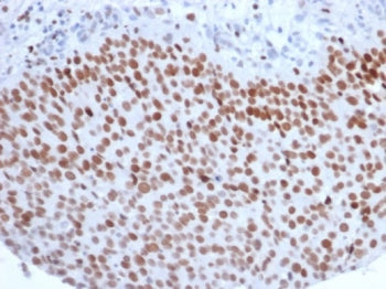 IHC staining of FFPE human bladder carcinoma with Enhancer of zeste homolog 2 antibody (clone EZH2/6