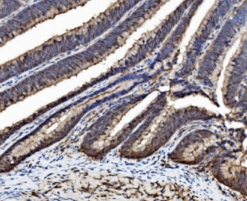IHC staining of FFPE human colorectal adenocarcinoma tissue with Caspase-6 antibody. HIER: boil tiss