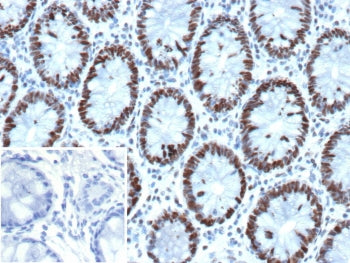 IHC staining of FFPE human colon tissue with recombinant GTBP antibody (clone MSH6/13194R). Inset: P
