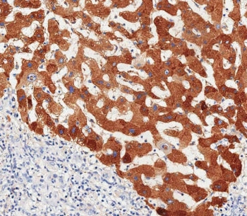 IHC testing of FFPE human hepatocarcinoma tissue with Haptoglobin antibody. HIER: steam section in p