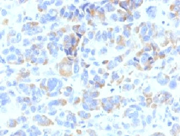 IHC: Formalin-fixed, paraffin-embedded human melanoma stained with TYRP1 antibody (clone TYRP1/807).