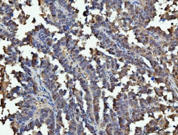 IHC staining of FFPE human ovarian serous cancer tissue with GAPDH antibody. HIER: boil tissue secti