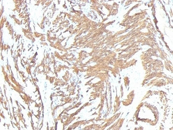 IHC: Formalin-fixed, paraffin-embedded human leiomyosarcoma stained with ACTA2 antibody cocktail (cl