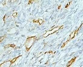 IHC testing of FFPE colon carcinoma and CD31 antibody (clone PCM25-1). Staining of formalin-fixed ti