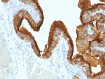 IHC: Formalin-fixed, paraffin-embedded human ovarian carcinoma stained with anti-MUC1 antibody (clon