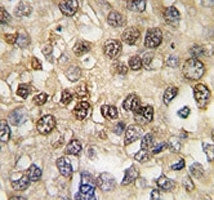 IHC analysis of FFPE human hepatocarcinoma tissue stained with RUNX2 antibody