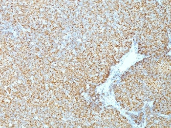 IHC: Formalin-fixed, paraffin-embedded human mantle cell lymphoma stained with Cyclin D1 antibody (C