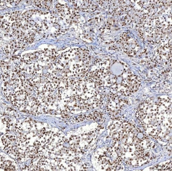 IHC staining of FFPE human lung adenocarcinoma tissue with TRMT61A antibody. HIER: boil tissue secti