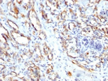IHC staining of FFPE human angiocarcinoma with CD31 antibody. HIER: steam sections in pH7.5-8.5, 1mM