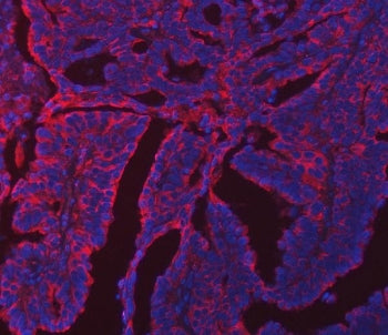 Immunofluorescent staining of FFPE human colon cancer tissue with ERP29 antibody (red) and DAPI nucl