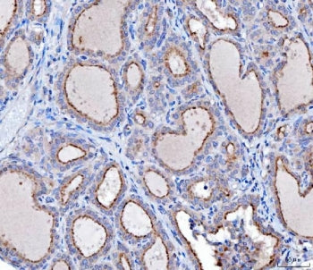 IHC staining of FFPE human thyroid cancer tissue with hDKIR antibody. HIER: boil tissue sections in