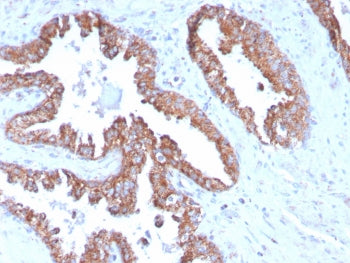 IHC staining of FFPE human prostate carcinoma with TMEPAI antibody (clone PMEPA1/2696). HIER: boil t