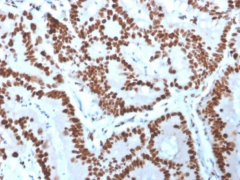 IHC staining of FFPE human colon carcinoma with MCM6 antibody. HIER: boil tissue sections in pH 9 10