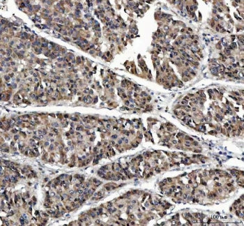 IHC staining of FFPE human liver cancer tissue with MAGEL2 antibody. HIER: boil tissue sections in p