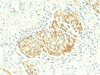 IHC staining of FFPE human colon carcinoma with recombinant CD56 antibody (clone NCAM1/2217R). HIER: