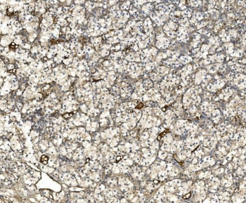 IHC staining of FFPE human renal carcinoma tissue with EIF3C antibody. HIER: boil tissue sections in