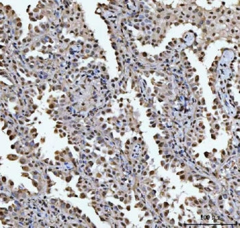 IHC staining of FFPE human lung cancer tissue with HOXC4 antibody. HIER: boil tissue sections in pH8